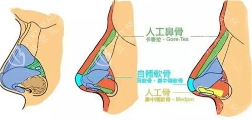 隆鼻手术对比