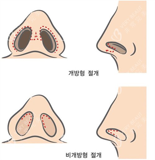 鼻翼矫正手术素材图