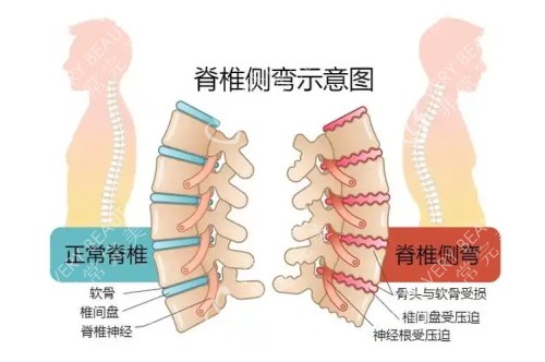 脊柱侧弯示意图