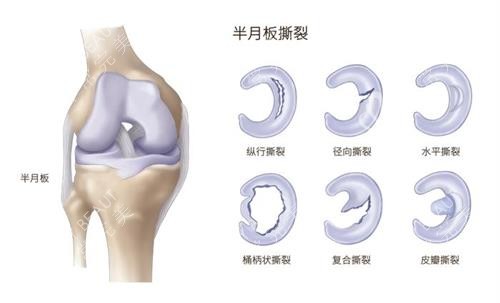 半月板撕裂示意图