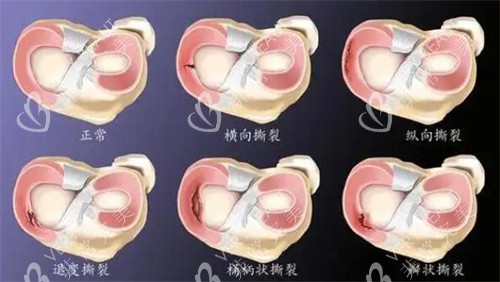 半月板损伤展示照片图