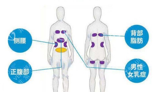 酷塑冷冻减脂适用部位