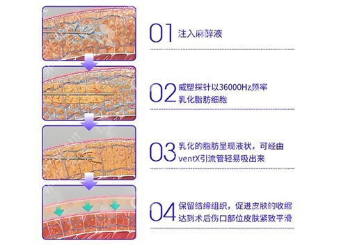 威塑吸脂手术步骤演示动画图