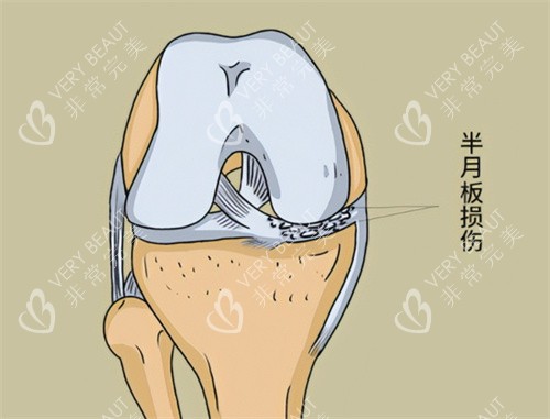 半月板损伤症状卡通图