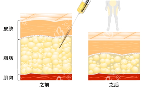 激光溶脂前后脂肪对比