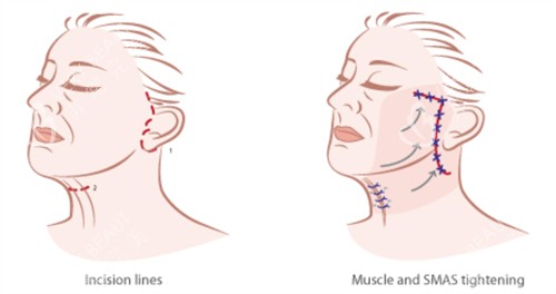 面部提升手术的对比和切口