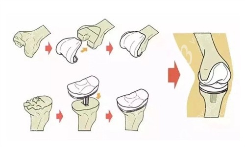 半月板置换手术示意图