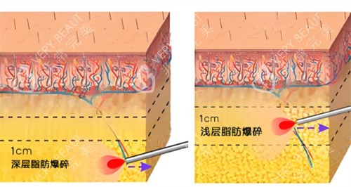 酷塑冷冻溶脂作用皮肤层图