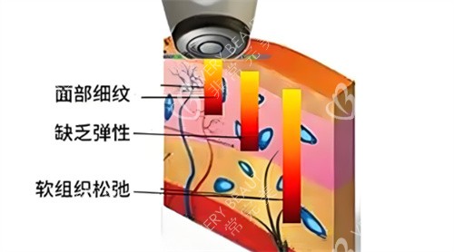 热拉提作用