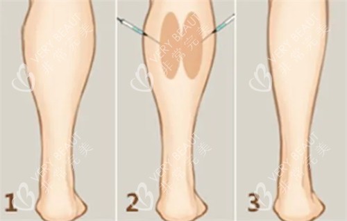 瘦腿注射前后变化