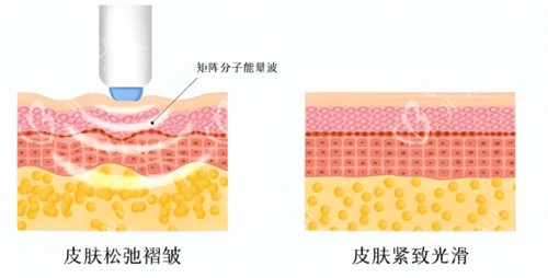 热玛吉作用对比