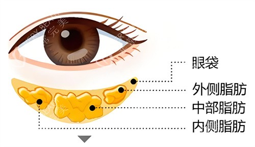 眼袋问题形成因