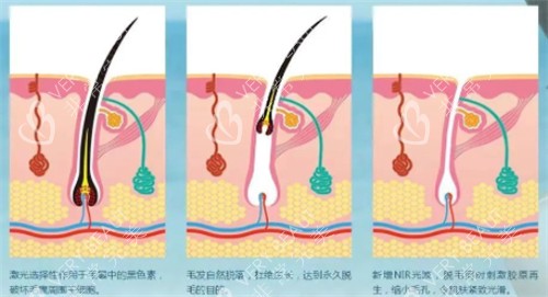 光子脱毛前后