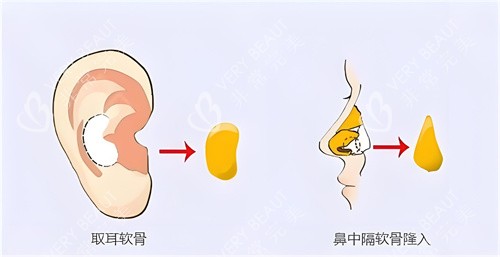 隆鼻耳软骨