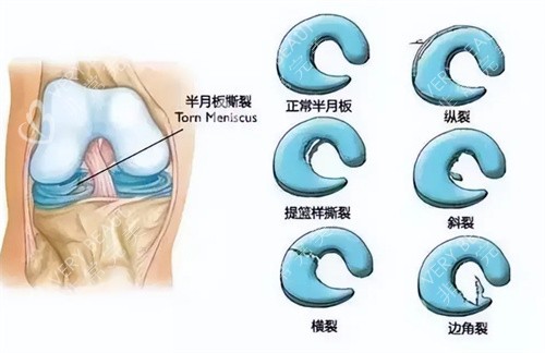 半月板损伤的不同情况