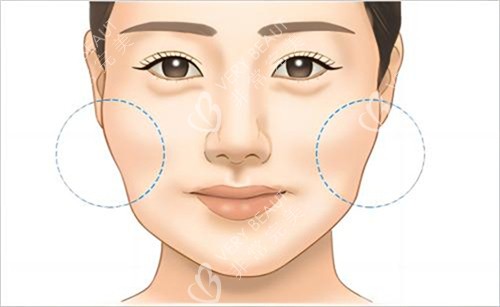 颧骨机脸颊下垂示例图