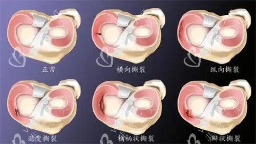 半月板损伤图片