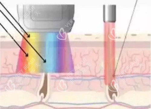 激光祛疤作用光波示意图