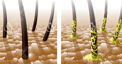 健康毛囊与脂溢性毛囊的区别对比图