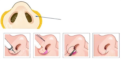 鼻翼缩小手术过程