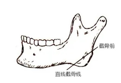 下颌角截骨简笔