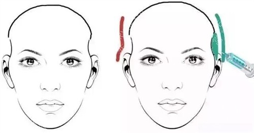 太阳穴凹陷玻尿酸注射对比动画图