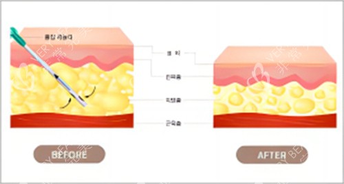 抽脂脂肪前后对比图