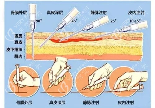 爱贝芙注射示意图