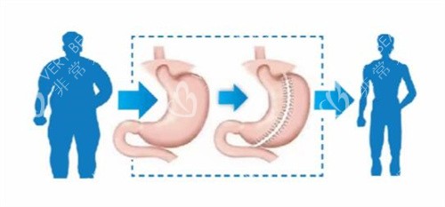 袖状胃切除手术优势卡通图