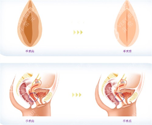 私密整形前后对比图