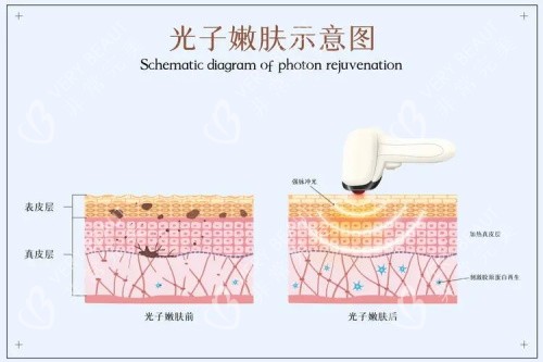 光子嫩肤的示意图