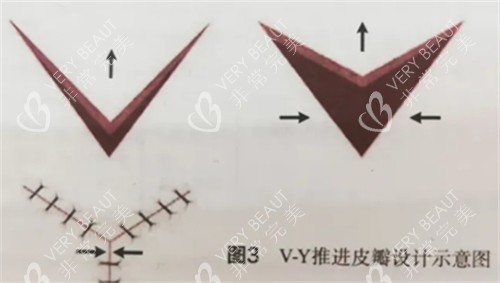 v-y成型法