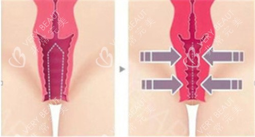 私密紧缩手术前后对比差异