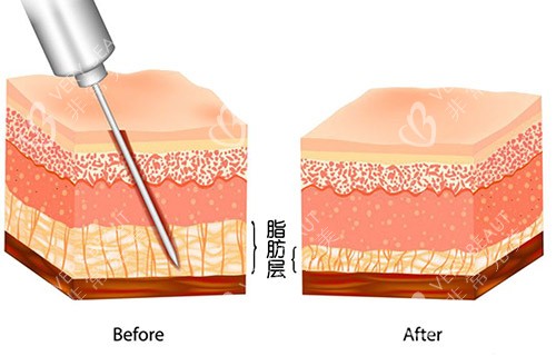 吸脂手术层级示意图