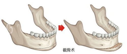 vline手术前后变化