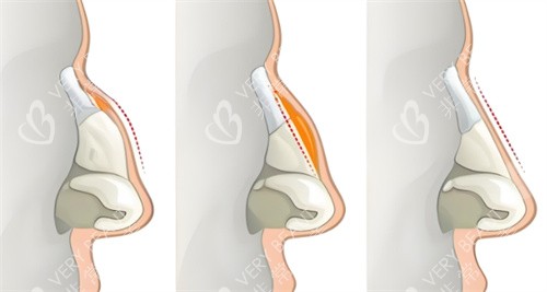 驼峰鼻矫正过程鼻部对比
