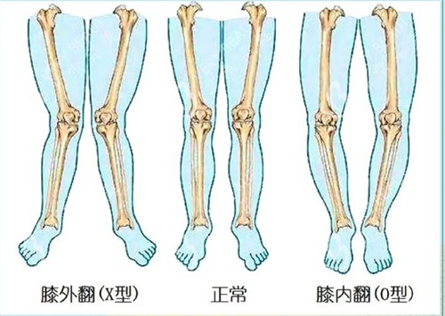 不同腿型对比动画演示