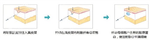 玻尿酸塑型原理