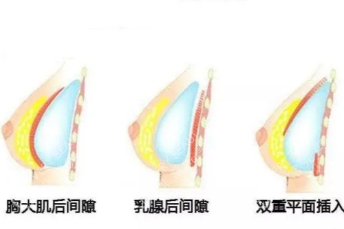 假体隆胸植入位置示意图