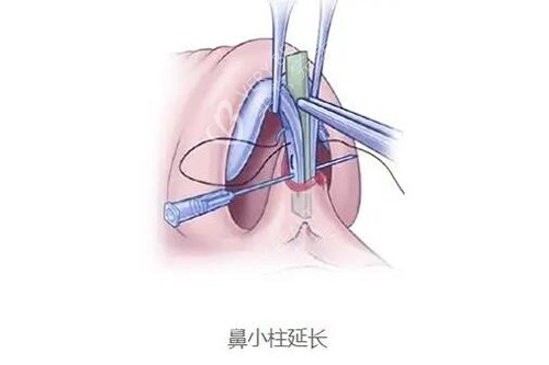 鼻小柱延长改善图