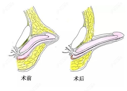 男性私密整形阴茎增长手术示意图