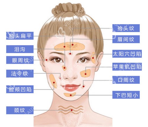 面部脂肪填充部位展示图