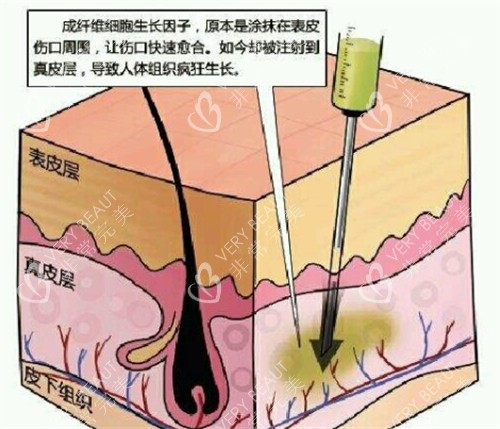 生长因子的副作用解析