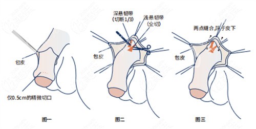 阴茎增长手术详细步骤演示动画图