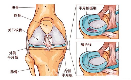 半月板撕裂缝合改善展示图