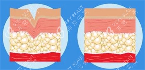爱塑美童颜针注射前后对比图