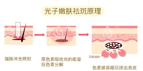 光子嫩肤的祛斑原理