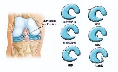 正常半月板和损伤半月板对比