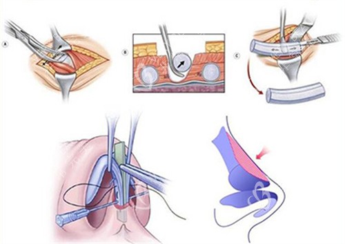 肋软骨隆鼻改善过程图