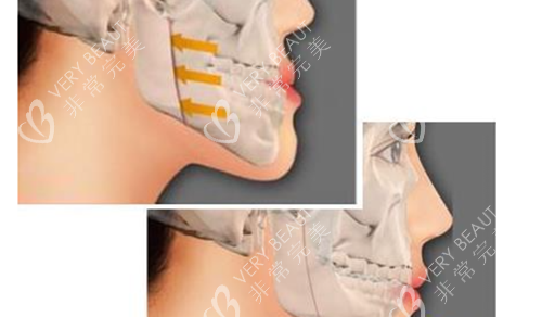 正颌手术示意图